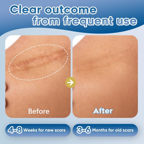 Advanced Silicone Scar Gel for Face & Body – Silicone Scar Cream for Old & New Scars, Reduces Appearance of Scars from Acne, Surgery, Burns, Injuries, C-Sections & More (1.76 Ounce)