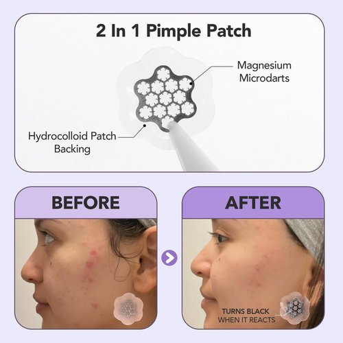 Magnesium Blemish Microdarts | Pimple Patch | Fast-Acting | Quick Calming | 99.9% Pure Magnesium | Madecassic Acid | Tea Tree | Eucalyptus Leaf | Hydrocolloid Spot Care Patch (Small 10 Patches)