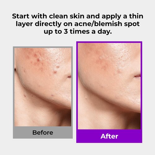 GLAM UP Spotless 10% Sulfur Treatment Serum - Fast Healing for Pimples & Acne | 15mL (0.5 fl. oz.)