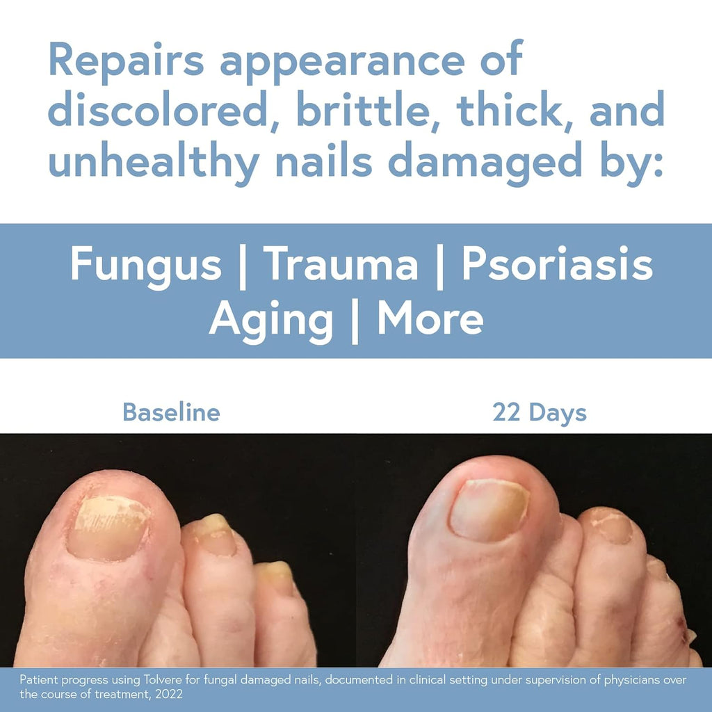 Tolvere Nail Renewal Solution - Revitalize Discolored, Brittle & Cracked Nails | Fast Results
