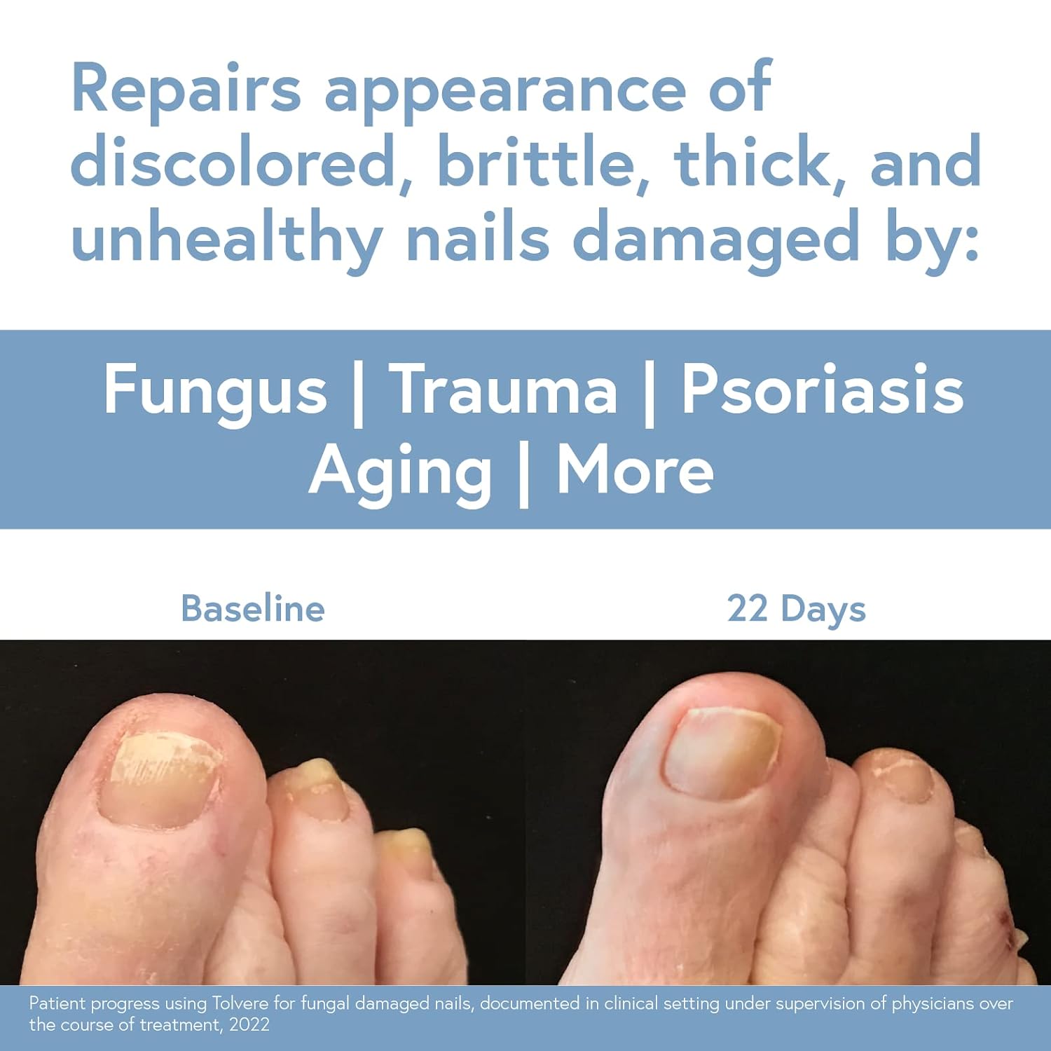 Tolvere Nail Renewal Solution - Revitalize Discolored, Brittle & Cracked Nails | Fast Results