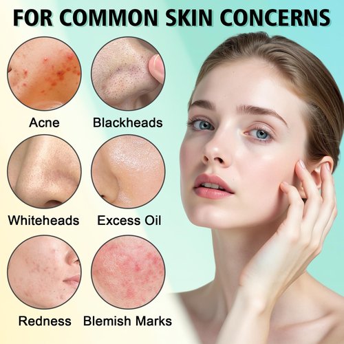 Acne Treatment for Face, Acne Cream, Pimple Cream Suitable for All Skin, Blemish Care Cream for Face and Body, Gentle Daily Skin Care for Oily & Blemish-Prone Skin, Helps Improve Skin Appearance