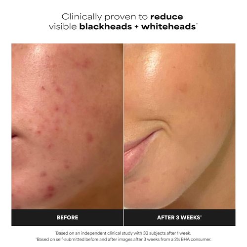 Paula's Choice SKIN PERFECTING 2% BHA Exfoliating Pads - Target Blackheads, Pores & Wrinkles