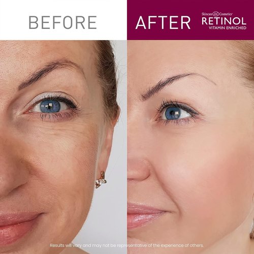 LIVAURA Retinol Cream Cleanser Anti-Aging – 5oz – Daily Deep Cleansing Facial Wash Improves Skin Texture, And Exfoliates for Softer Face – Renewing Vitamin A Minimizes Wrinkles and Fine Lines