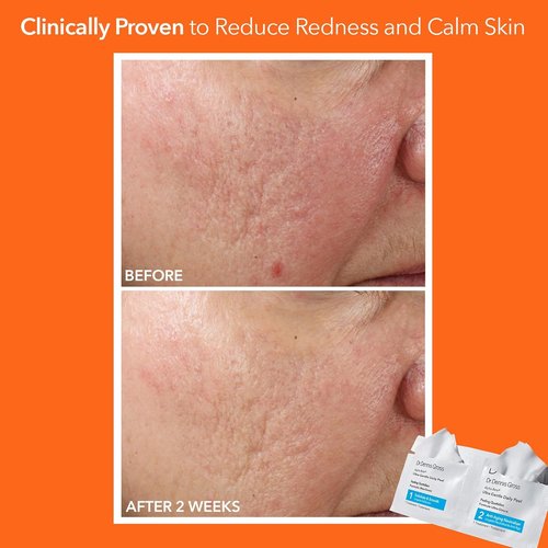 Dr. Dennis Gross Alpha Beta Ultra Gentle Daily Peel - Revitalize Dehydrated Skin | 30 Treatments