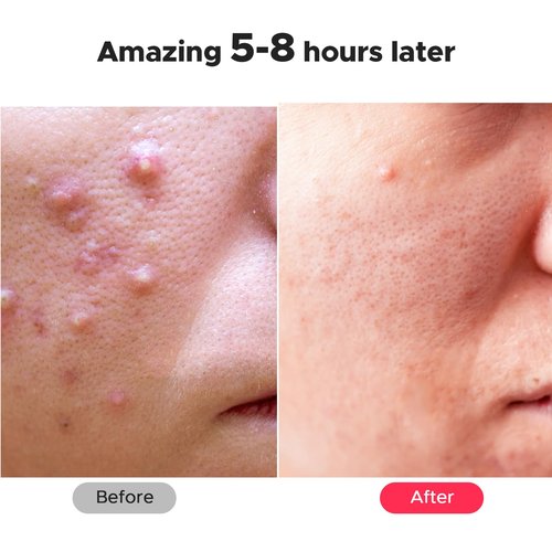 LitBear Large Pimple Patches, 5 Sizes 324 Patches Big Acne Patches, XL Hydrocolloid Bandages for Full Face, Forehead, Chin, Nose, Body, Back, Neck & Chest, Stirp, Square Large hydrocolloid Patch