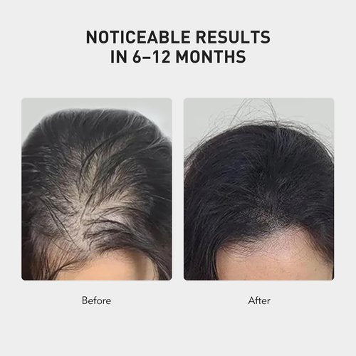 KINTOR Hair Regrowth Spray 0.9% KX-826 - Supports Healthy Hair Growth & Oil Control | 60ml