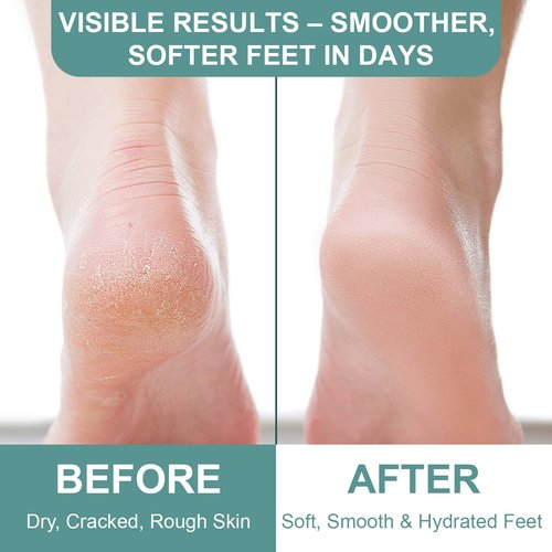 60% Urea Cream for Feet with 2% Salicylic Acid, Foot & Hand Cream for Dry Cracked Heels with Jojoba Oil, Avocado Oil & Aloe Vera, Urea Lotion for Elbows, hands, Knees & Callus Remover, 8.45 oz