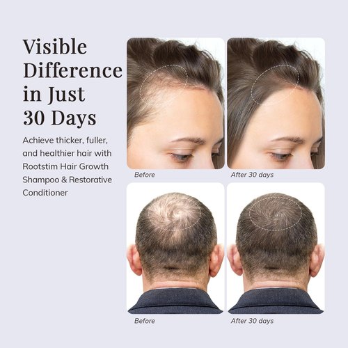 Skiennix Hair Growth Shampoo & Conditioner Set - Rosemary & Biotin for Thickening & Healthy Scalp