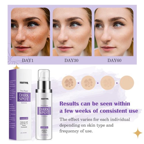 HANYWIL Dark Spot Remover for Face & Body Serum with Retinol & Niacinamide - Corrects Melasma, Sun & Age Spots, Hyperpigmentation Treatment for All Skin, Dermatologist Tested (1.7 Fl Oz)