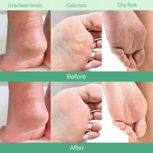 PLANTIFIQUE Foot Peeling Mask 4 Pack | Dermatologically Tested Repairs Heels & Removes Dry Dead Skin for Baby Soft Feet | Exfoliating Foot Peel Mask for Dry Cracked Feet