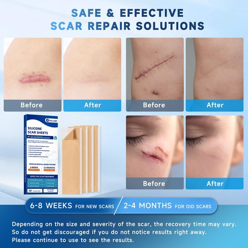 Rvlaim Silicone Scar Sheets, Silicone Scar Tape(5.7” x 1.57” 10 Pcs), Silicone Scar Sheets for Surgical Scars, Keloid Bump Removal, Stretch Marks Removal, C-Section, Burn et