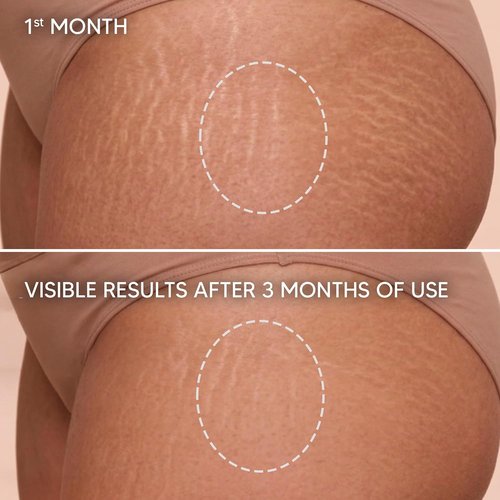 Cicatrissim Stretch Mark Cream - Softens & Firms Skin, Evens Tone - 150g for All Skin Types