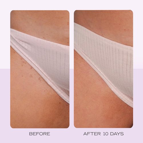 **KP Bump Eraser Body Scrub & Ingrown Hair Pads Duo by Jumbo Body | Exfoliating Treatment for Keratosis Pilaris (10 oz Scrub, 60 Ct Pads)**