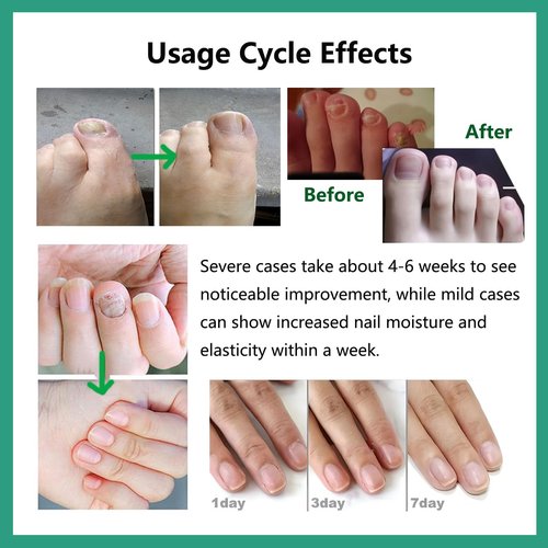 Natural Nail Care Gel, Nutraboost Strengthening Cuticle Serum for Damaged & Brittle Nails, 20ml (1 pcs) (2pcs)
