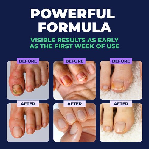 Orivelle Nail Fungus Pen – Professional Nail Repair & Strengthening Solution with Tea Tree Oil – Improves Appearance of Discolored or Damaged Nails (Pack of 2)