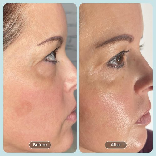 30 Day Miracle BHA 20% Peeling Solution - Clinical Strength Exfoliant for Clogged Pores & Wrinkles - 1oz Salicylic Acid Serum