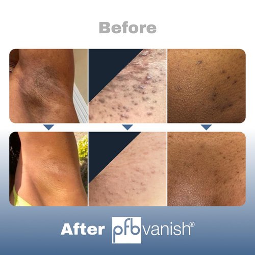 PFB Vanish Razor Bump Stopper Skin Care Treatment with Chromabright Dark Spot Remover, Roll On Formula Treats Ingrown Hairs and Razor Burns - 93g