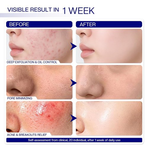 Morovan Glycolic Acid Pads - 30% Dual-Sided Face Exfoliator for Clear Skin Tone | 65 Pads