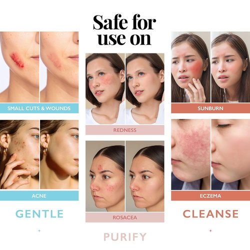 Hypochlorous Acid Spray - Antimicrobial Facial Cleanser for Acne & Skin Issues | 8oz Face Mist
