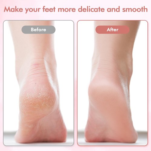 Electric Foot File and Callus Remover,Professional Pedicure Tools for Dry, Calluses, Dead, Cracked, Hard Skin,Equipped with 2 Grinding Heads and 1 Cleaning Brush