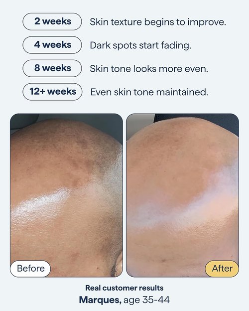 Dr. Shah Remedy for Dark Spots - Advanced Night Treatment with Retinol & Kojic Acid | 1 fl. oz for Uneven Skin Tone