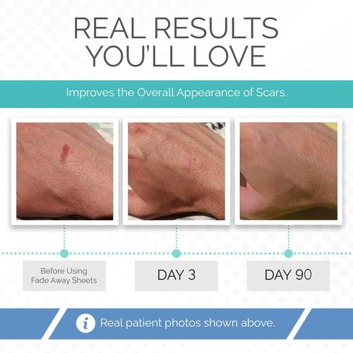 Clinically Proven Silicone Scar Sheets – Medical Grade Tape for Surgery, C-Section, Keloids & Tummy Tuck Scars