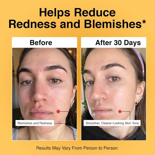 Foundation Skincare Azelaic Acid 14% - Dermatologist-Approved Formula for Blemish-Prone Skin (1 Fl Oz)
