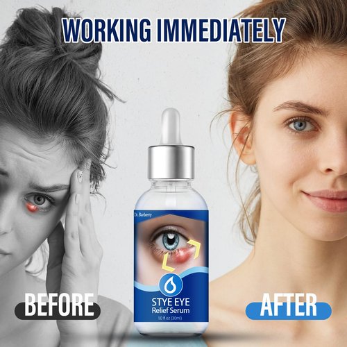 Stye Eye Treatment, Eye Stye Relief Serum, Natural & Gentle Stye Cure, Non-Irritating Formula, Target Chalazions & Blepharitis (1 Fl Oz (Pack of 1))