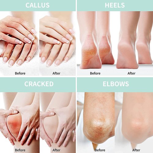 Grocerism Urea Cream 40 Percent For Feet Plus 2% Salicylic Acid 8.82 oz || Foot Cream and Hand Cream Maximum Strength with Hyaluronic Acid, Tea Tree,and Aloe Vera for Deep Moisturizes, Callus Remover