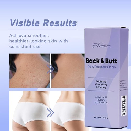 Regine Switzerland Butt Acne Clearing Treatment - Maximum Strength Body Cream for Bacne & Cystic Acne - Unisex Skin Lotion
