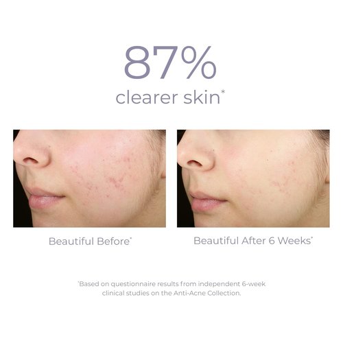 DERMA E Acne Spot Treatment Serum - Clinically Proven Formula for Blackheads & Breakouts | 2 Fl Oz