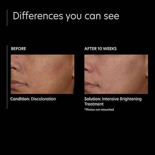 PCA SKIN Intensive Brightening Treatment | 0.5% Pure Vitamin A Retinol Serum for Dark Spots (1 oz)