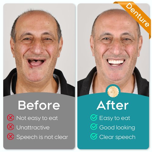 Dentures DIY Kit, Create Your Perfect Smile at Home: DIY Denture Fake Teeth Kit - Easy, Affordable, and Customizable Denture Solution-AEE1115