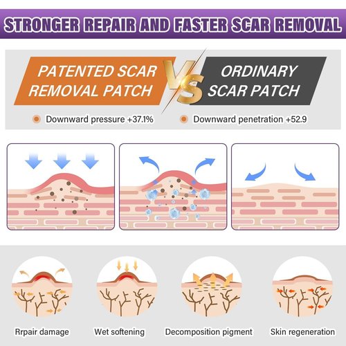 Silicone Scar Sheets,Silicone Scar Tape,Silicone Scar Removal Strips for Surgical,C-Section,Tummy Tuck,Keloid Scars (1.6"X 157" Roll-4M) Keloid Bump Removal