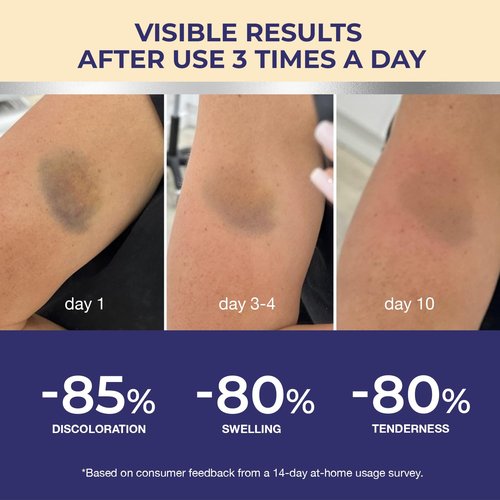 Arnica Bruise Cream Extra Strength: Fast Healing Arnica Cream for Bruising Swelling Thin Skin-Enhanced Recovery Vitamin K Creams With Arnica Montana, VK, C&E– Soothing Hydrating for senior, Adult, Kid
