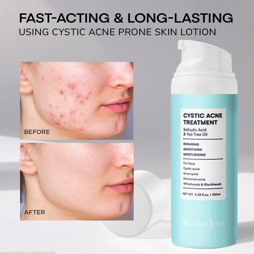 BellamiLuxx Cystic Acne Treatment for Face: Hormonal Acne Treatment Cream for Teens & Adults - Salicylic Acid & Tea Tree Oil Pimple Spot Remover - Anti-Acne Moisturizer Reduces Redness, Blemishes