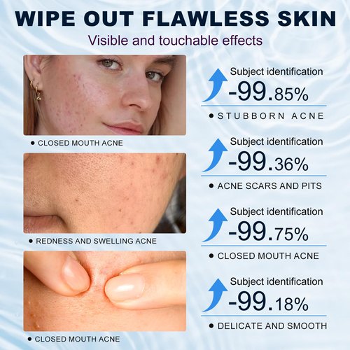Azelaic Acid 10% Cream for Face - Acne Cream for Rosacea Reducing Relief Pimple Breakouts Blackhead Pigmentation and Redness - Azelaic Acid Gel For Facial and Skin Care