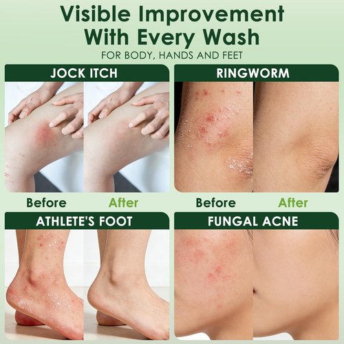 Oiangna Antifungal Soap, Tea Tree Antifungal Soap Bar for Back Acne, Athlete's Foot, Tinea, Ringworm, Jock Itch, Face & Body Wash Soothing Care for Men And Women, Relief of Itchy