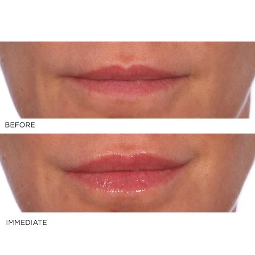 NassifMD Hydro-Screen Lip Plumping Oil - Hydrating Hyaluronic Acid Serum for Soft, Smooth Lips