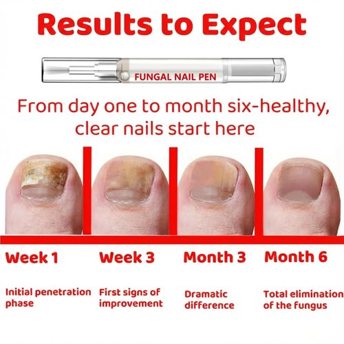 Fungal Nail Pen with Allicin & 25% Undecylenic Acid, Nail Repair Pen | Extra Strength Nail | Toenail & Fingernail Care 2pcs