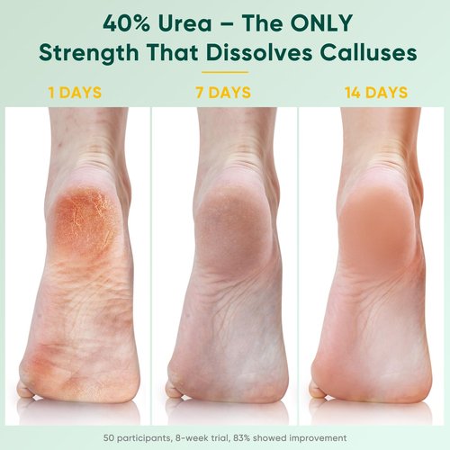 Berlaney Urea Cream 40 Percent For Feet Maximum Strength plus 2% Salicylic Acid 5.29 oz, Fast-Absorbing Foot Cream for Dry Cracked Skin with Tea Tree ＆ Aloe Vera, Callus Remover, Deep Moisturizing