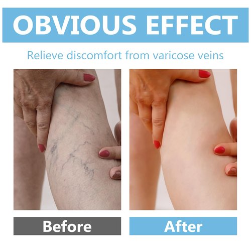 ITECFREELY Varicose Veins Cream, Improve Blood Circulation Varicose Veins Care, Fast Soothe Cream for Legs