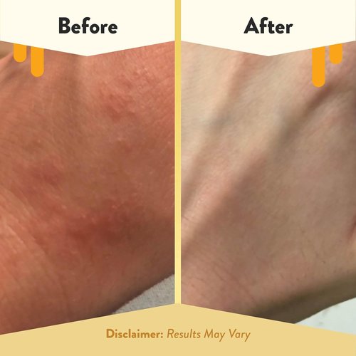 ECZEMA HONEY Oatmeal Body Lotion - Natural Eczema Relief Hand & Body Cream - 16 Oz for Dry Skin Repair
