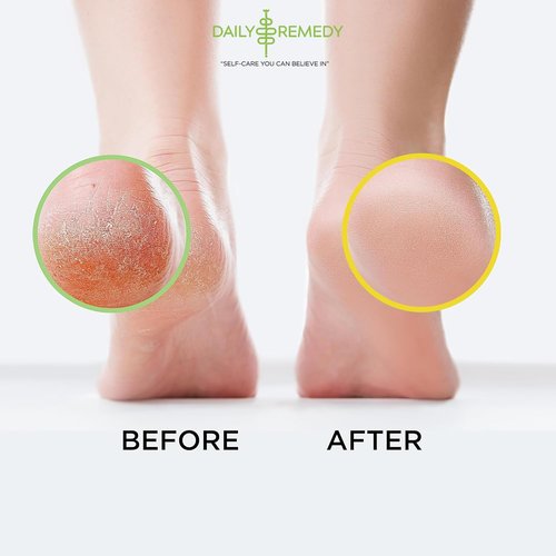 DAILY REMEDY 4-Pack Foot Soak Set - 2 Extra Strength Tea Tree Oil & 2 Citrus Detox - Made In USA - Soothes Tired Feet, Athletes Foot, Stubborn Foot Odor, Softens Calluses & Refreshes & Detoxifies