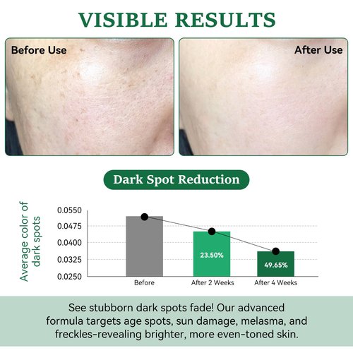 Dark Spot Remover for Face and Body - Dark Spot Corrector for Sun Spots Age Spots Freckles Melasma Brown Spot - Dark Spot Correcting Glow Serum with 360-Degree Roller 0.67 Fl Oz