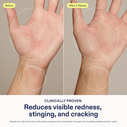 Skinfix Hand Relief Cream - 3 Fl Oz | Soothes Redness & Cracking for Dry, Sensitive Skin - Eczema Approved, Fragrance-Free, Vegan