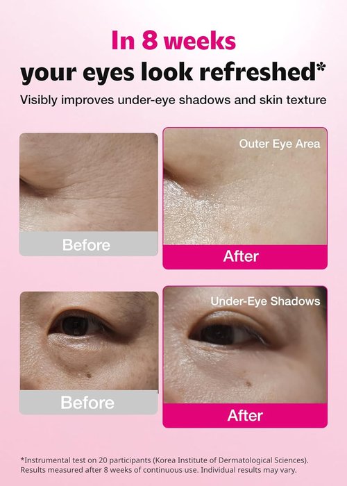 ISOI Blemish Care Under Eye Patch - Hydrating Gel Eye Masks for Dark Circles & Puffiness | 90 Pcs, 3.17 Oz