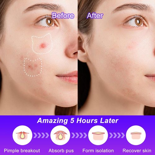 CELECARE Cat Pimple Patches,Cute Pimple Patches,Acne Patches for Face, Cute Stickers,Salicylic Acid & Tea Tree, 120 Hydrocolloid Dots in 20 Colors for Face,Cute Cat Pimple Stickers