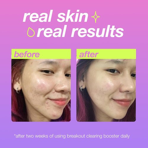 Dermalogica Clear Start Acne Spot Treatment - Breakout Clearing Booster with Salicylic Acid (1 Fl Oz)